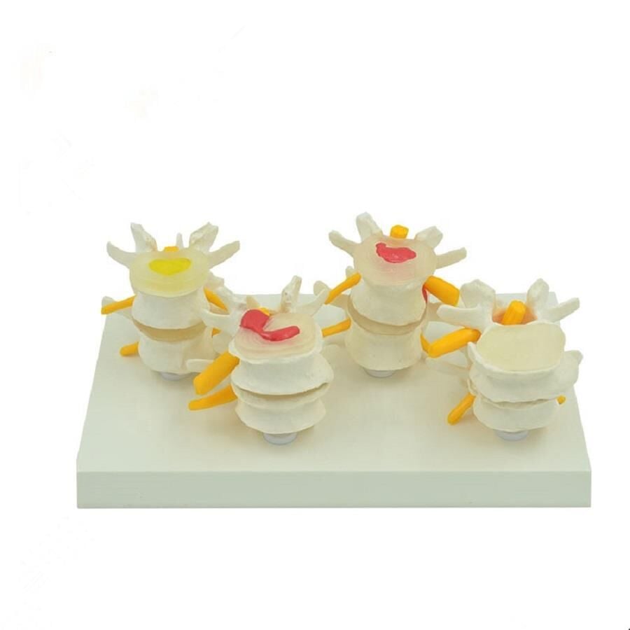 Dört Aşamalı Fıtık Maketi Model 3