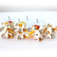 Dört Aşamalı Fıtık Maketi Model 3