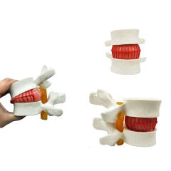 Disk Hernisi Fıtık Maketi Model 2
