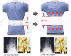 Bel Manuel Terapi ve Bel Traksiyon Korsesi