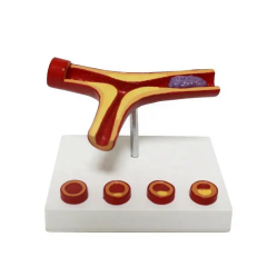 Damar Tıkanıklığı Model 46